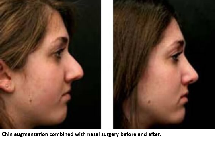 Chin Implant Size Chart