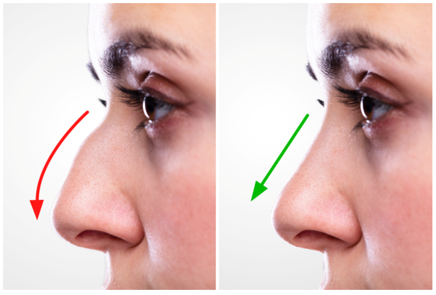 Rhinoplasty Experience - AssocProfDrSuleyman TAS