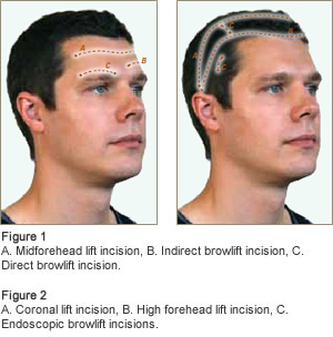 Forehead surgery