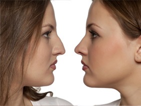 Rhinoplasty